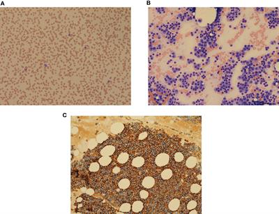 Case Report: Effects of multiple myeloma therapy on essential thrombocythemia and vice versa: a case of synchronous dual hematological malignancy